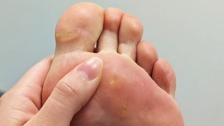 Behandeling van likdoorns